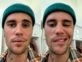 Justin Bieber tiene parálisis facial parcial