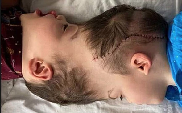 Bernardo y Arthur Lima siameses unidos por la cabeza