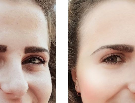 ¡S.O.S. ojeras! Causas, prevención y tratamiento