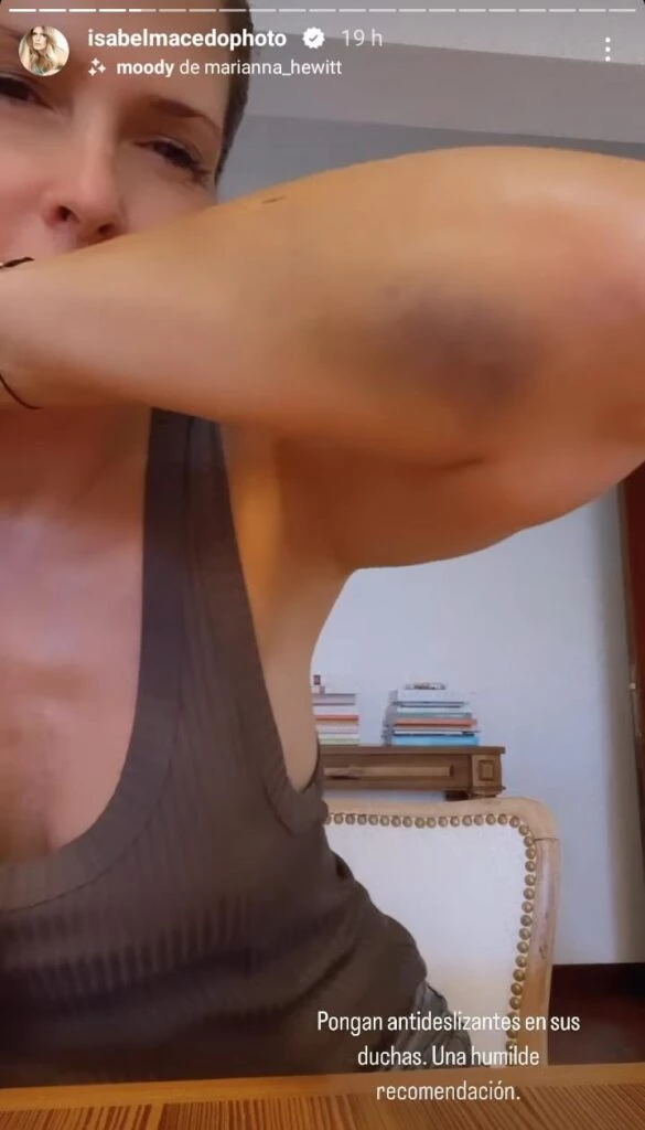 Isabel Macedo mostró el golpe que sufrió en su brazo tras su accidente doméstico