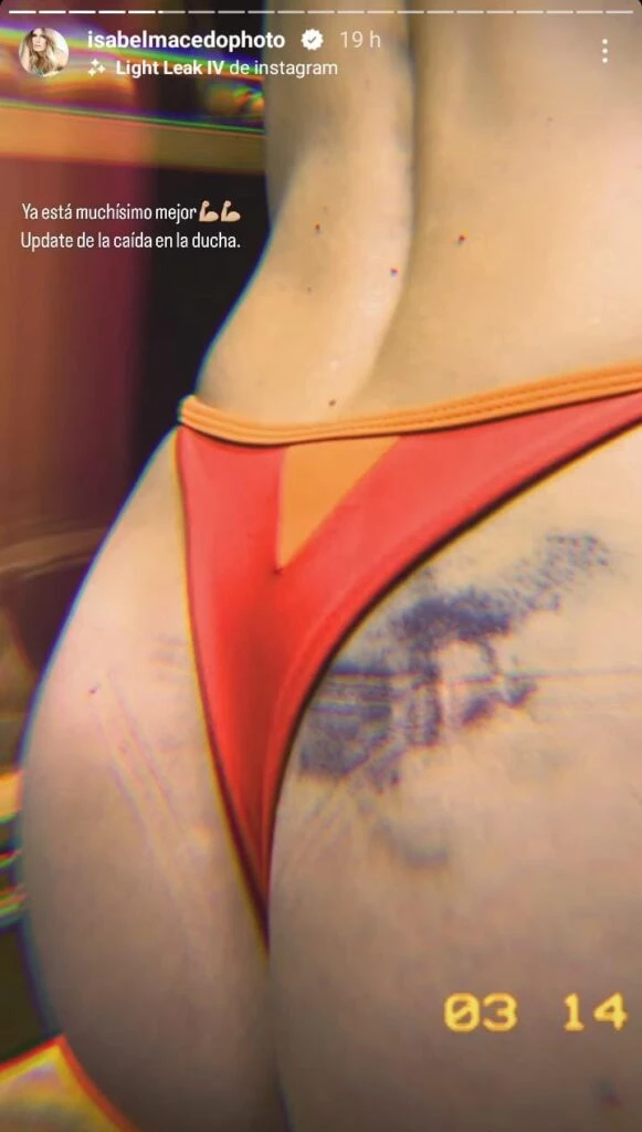Isabel Macedo mostró los golpes que sufrió cuando se resbaló en la ducha