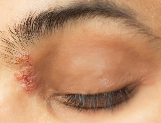 Herpes Zóster (o "Culebrilla"): todo lo que tenés que saber sobre este virus que puede complicar tu salud