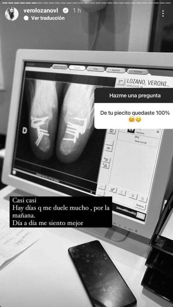 Vero Lozano contó cómo están sus pies a más de un año de su accidente