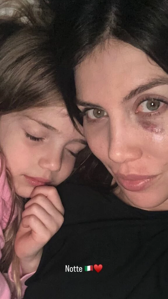 Wanda Nara se golpeó la cara.