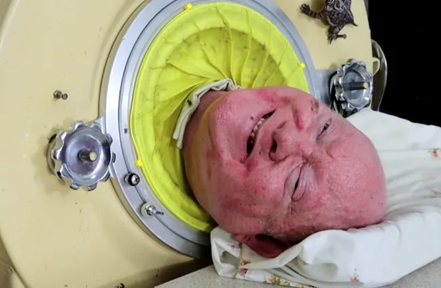 Paul Alexander cuando era niño: contrajo poliomielitis a los 6 años.