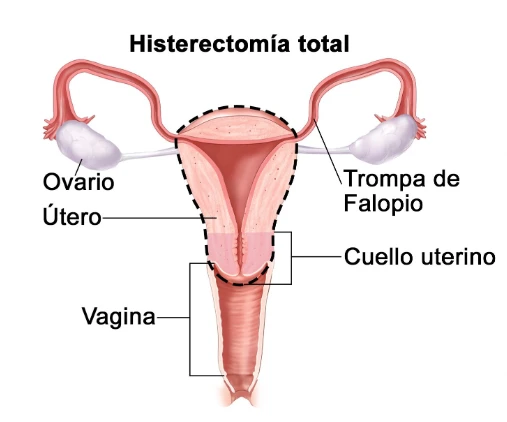 Qué es una histerectomía abdominal. Foto portal del Instituto Nacional del Cancer de EE.UU.