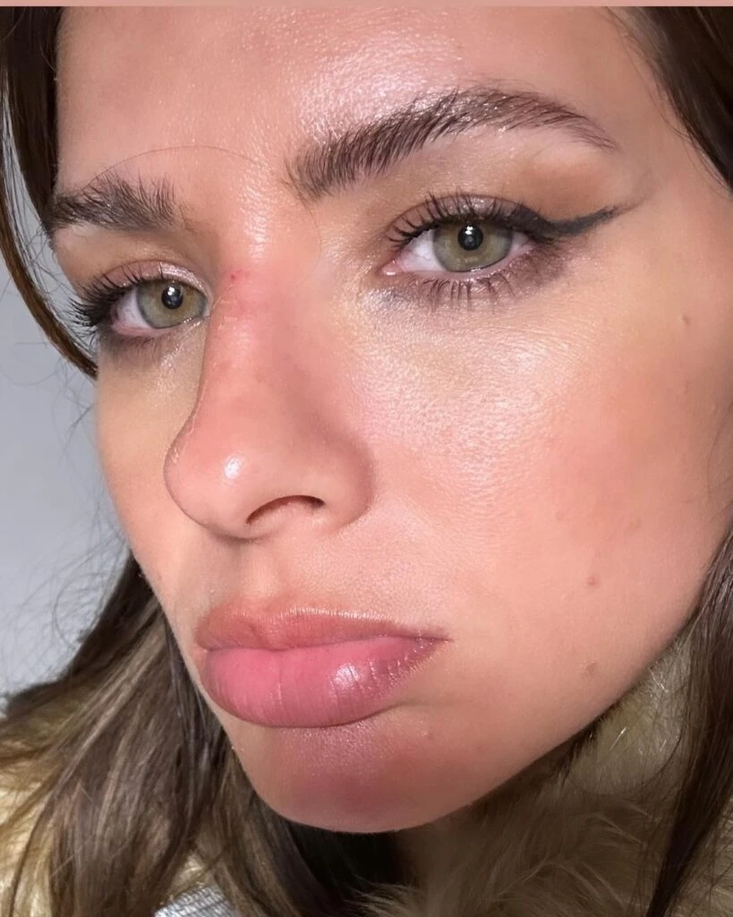 La China Suarez contó cómo sigue su nariz tras la fractura