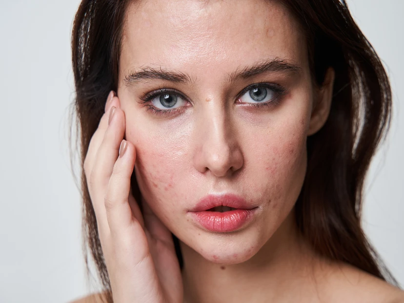 Acné, una condición estética que impacta mucho más que la piel