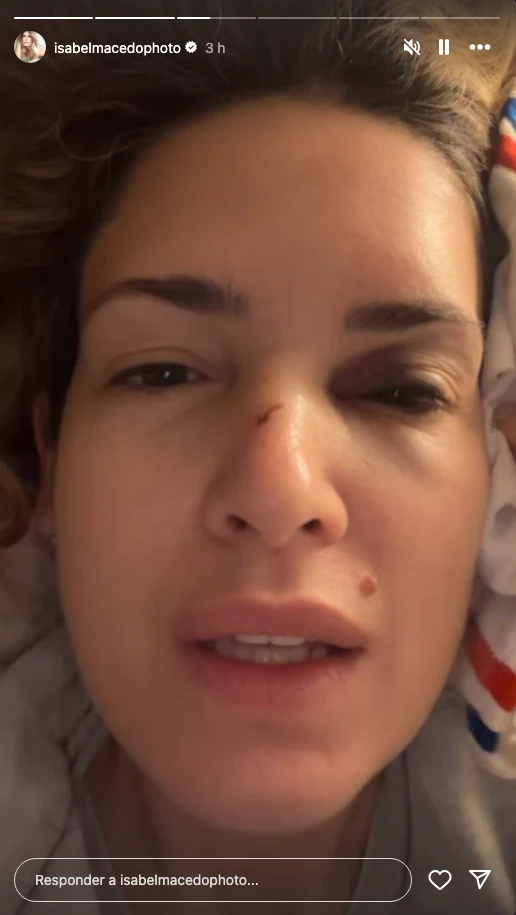 Isabel Macedo mostró cómo quedó su cara tras accidentarse