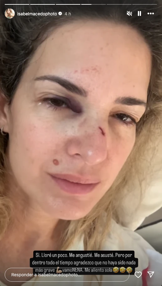 Isabel Macedo mostró cómo quedó su cara tras accidentarse
