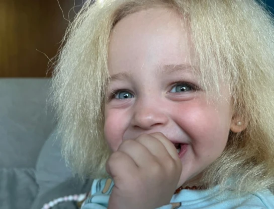 La historia de Coco, la nena con síndrome del pelo indomable