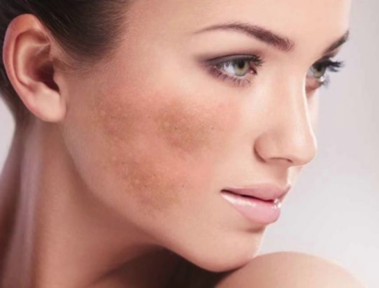 Manchas en la piel: por qué aparecen, cómo se tratan y cuándo consultar al dermatólogo