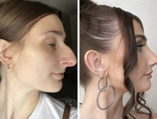 Una cirugía de nariz le cambió la vida: la historia de la influencer que encontró su identidad gracias a su nueva apariencia