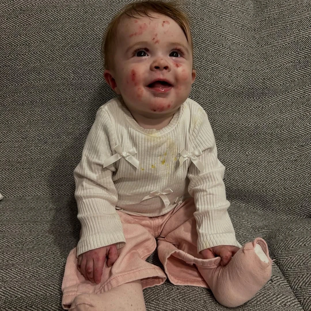 Júlia, la beba que nació con piel de mariposa