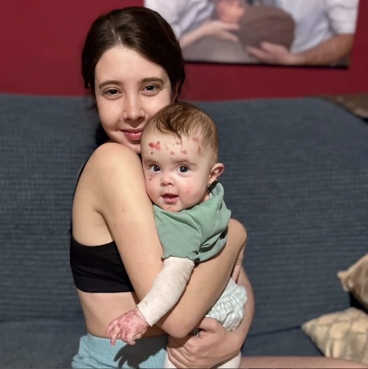 Júlia, la beba que nació con piel de mariposa