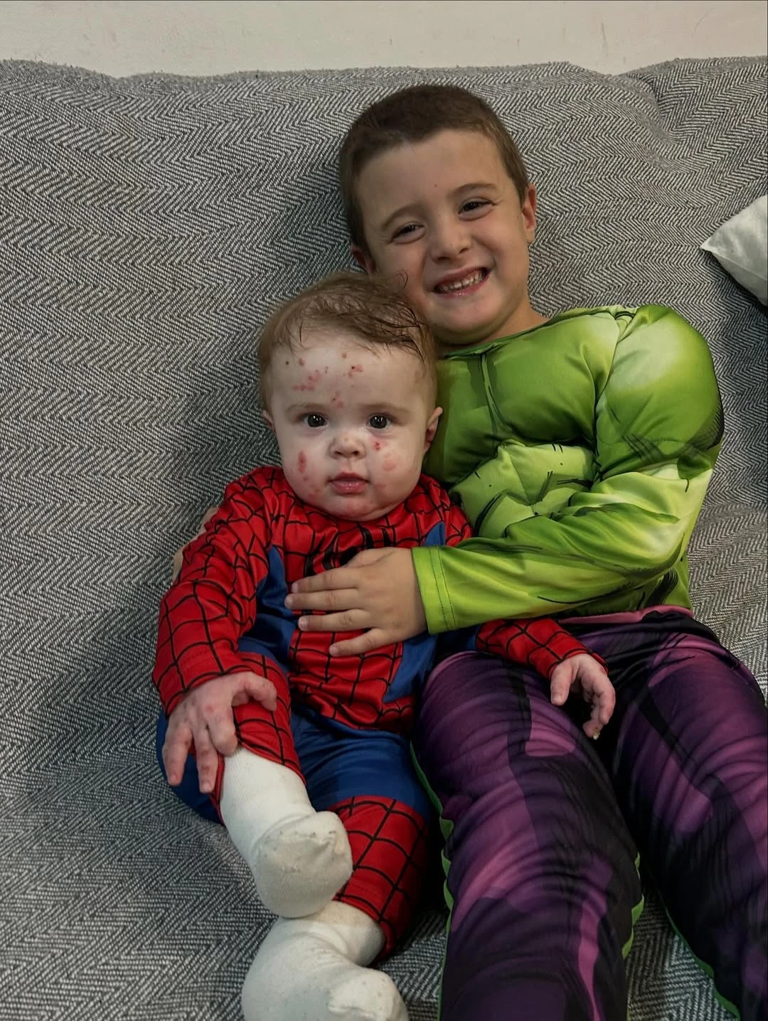 Júlia, la beba que nació con piel de mariposa