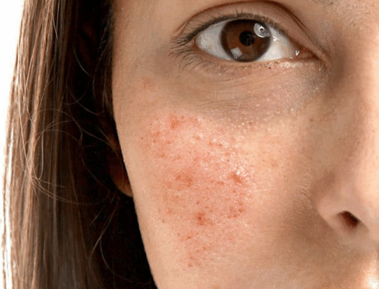 5 tips esenciales para evitar manchas en la piel: los consejos de un dermatólogo