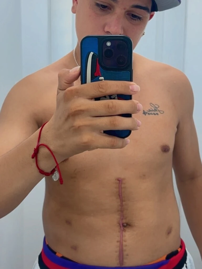 Thiago Medina se animó a mostrar las cicatrices que le quedaron tras su internación al sufrir un accidente en moto. 