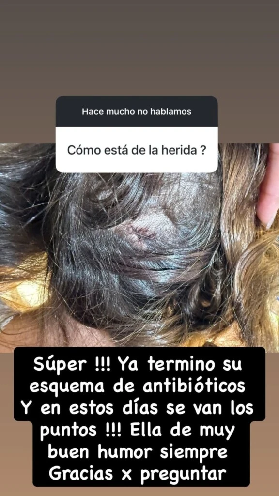 Barby Franco mostró cómo se encuentra la herida de su hija de tres años. Foto: Instagram