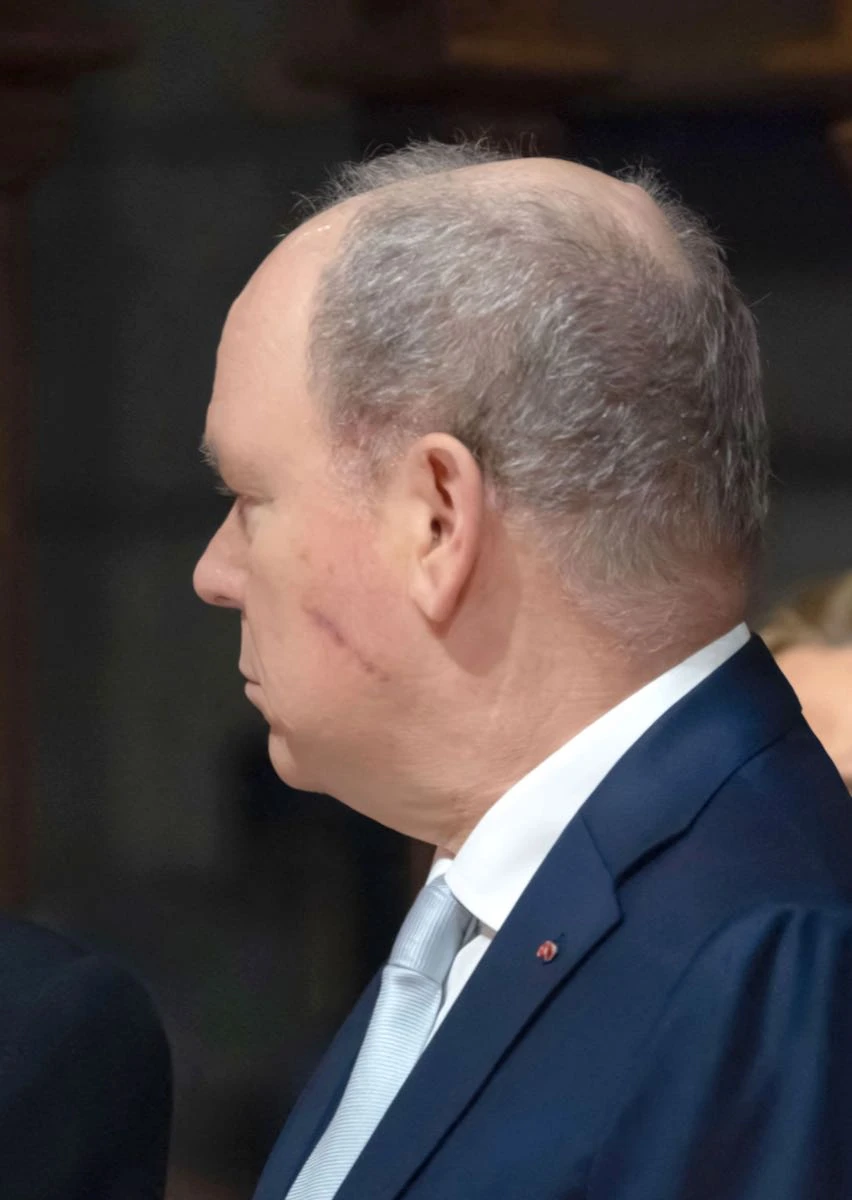 La cicatriz que despertó rumores sobre la salud del príncipe. 