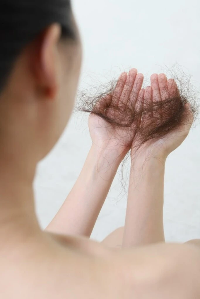 Si la caída supera los 150 pelos diarios, podría tratarse de este cuadro. Foto: Pinterest