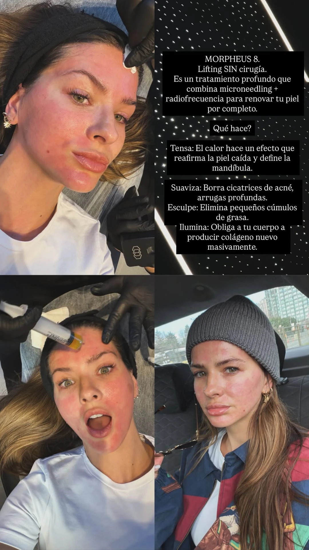 La China Suárez se hizo el tratamiento facial que promete un lifting sin cirugía y es furor entre las famosas