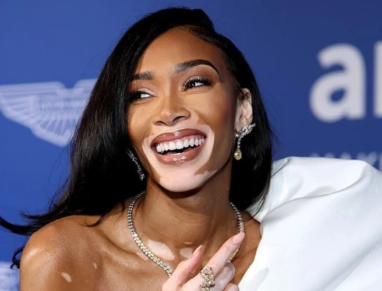 El vitiligo: por qué es una enfermedad y no una cuestión estética