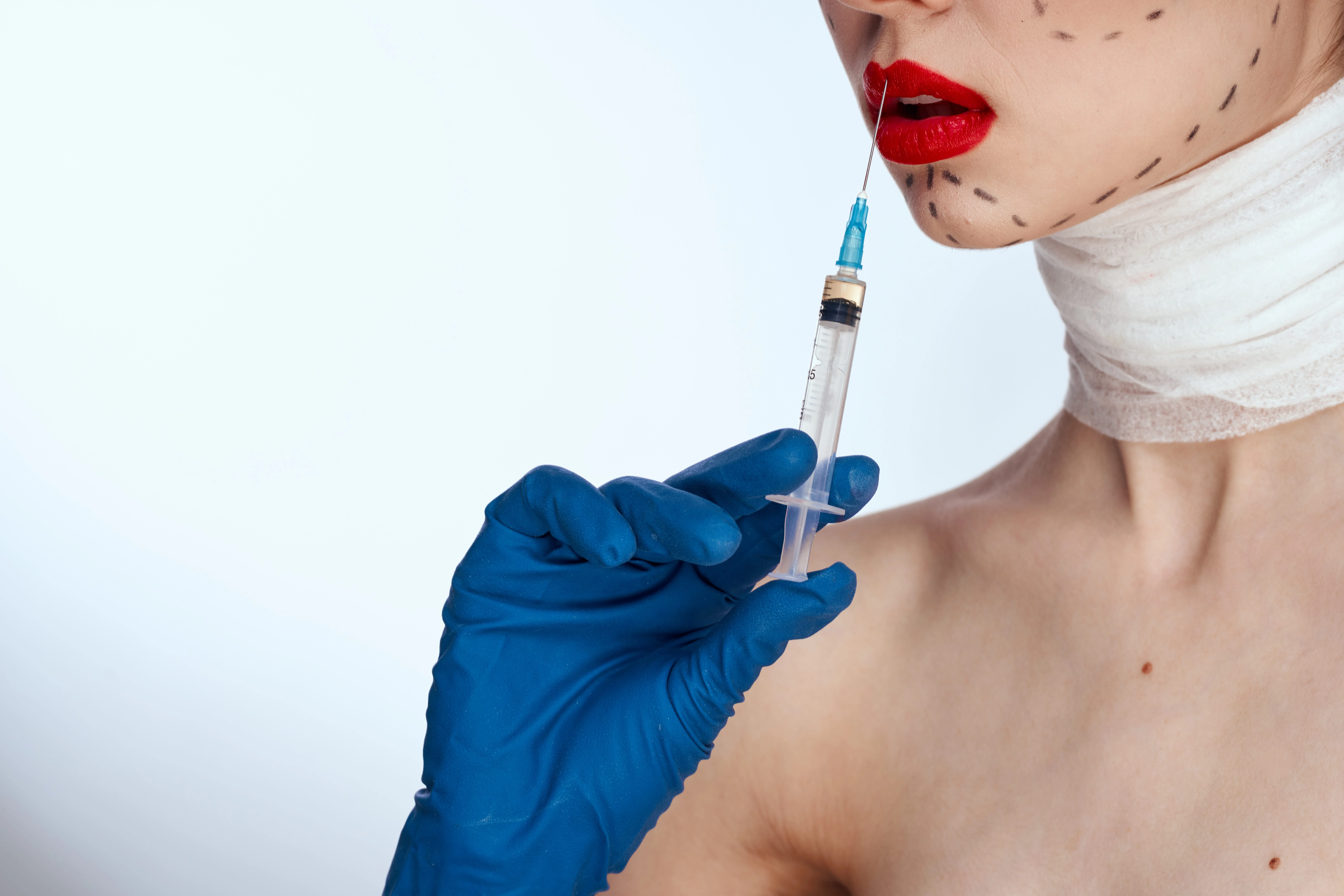 Zombie fillers: el polémico relleno con tejido de donantes que nació tras el boom del Ozempic