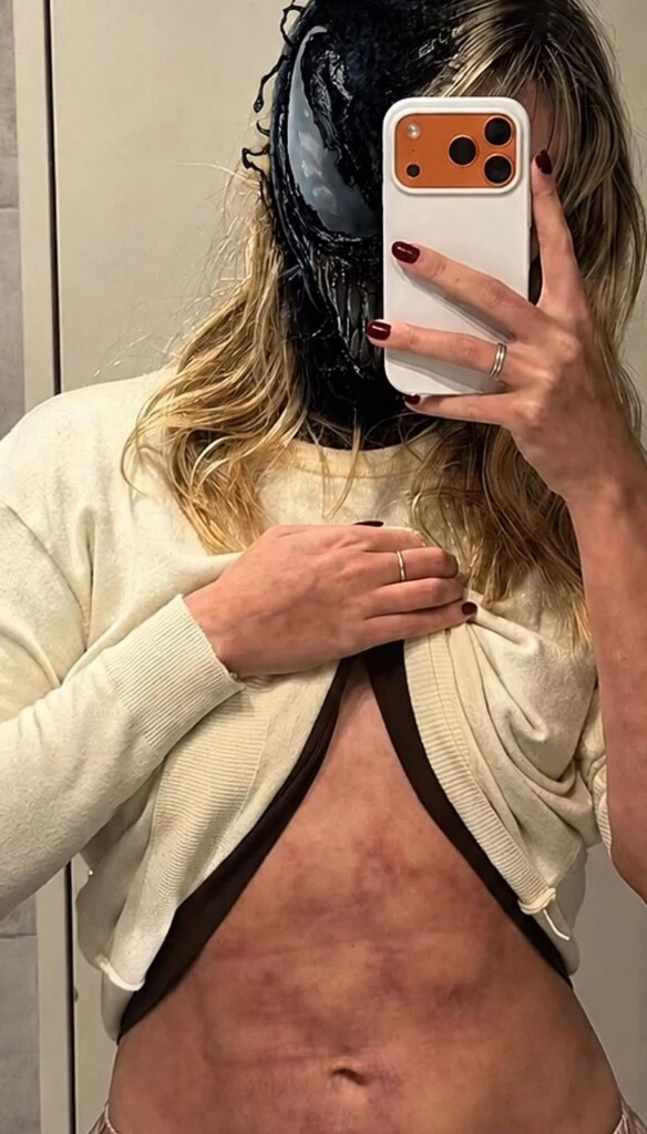 Más adelante, mostró una irritación que apareció en sus brazos y en la zona del abdomen. La piel se veía más rosada que de costumbre y con una distribución irregular.